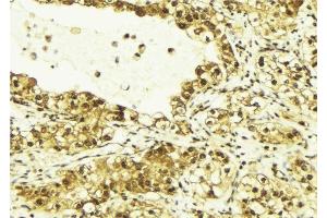 ABIN6269138 at 1/100 staining Human breast cancer tissue by IHC-P. (SRF 抗体  (N-Term))