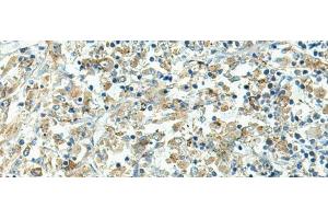 Immunohistochemistry of paraffin-embedded Human liver cancer tissue using FCGRT Polyclonal Antibody at dilution of 1:45(x200) (FcRn 抗体)