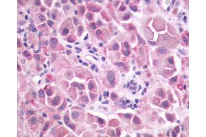 Anti-GRM3 / MGLUR3 antibody IHC of human Skin, Melanoma. (Metabotropic Glutamate Receptor 3 抗体  (N-Term))