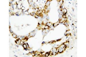 Anti-MEK3 antibody, IHC(P) IHC(P): Human Mammary Cancer Tissue (MAP2K3 抗体  (C-Term))