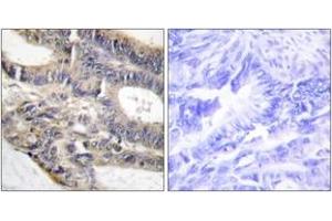 Immunohistochemistry analysis of paraffin-embedded human colon carcinoma tissue, using AS250 Antibody. (RALGAPA2 抗体  (AA 641-690))