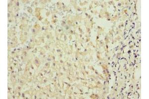 Immunohistochemistry of paraffin-embedded human liver cancer using ABIN7172975 at dilution of 1:100 (TMED2 抗体  (AA 26-111))
