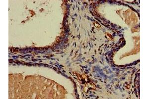Immunohistochemistry of paraffin-embedded human prostate cancer using ABIN7146559 at dilution of 1:100 (CNN3 抗体  (AA 2-329))