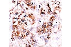 IHC analysis of FFPE human hepatocarcinoma stained with the DUSP15 antibody (DUSP15 抗体  (AA 17-44))