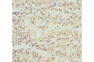 Immunohistochemistry of paraffin-embedded human gastric cancer using ABIN7162248 at dilution of 1:100 (OPA3 抗体  (AA 25-179))
