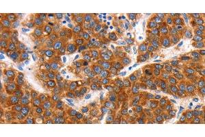Immunohistochemistry of paraffin-embedded Human liver cancer tissue using KCNC2 Polyclonal Antibody at dilution 1:100 (KCNC2 抗体)