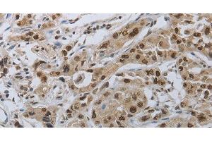 Immunohistochemistry of paraffin-embedded Human lung cancer using PRKAR1B Polyclonal Antibody at dilution of 1:70