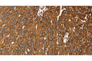 Immunohistochemistry of paraffin-embedded Human breast cancer tissue using RASSF3 Polyclonal Antibody at dilution 1:35 (RASSF3 抗体)