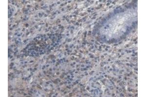 Detection of SYMPK in Human Colorectal cancer Tissue using Polyclonal Antibody to Symplekin (SYMPK) (Symplekin 抗体  (AA 1-347))
