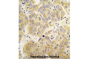 Formalin-fixed and paraffin-embedded human hepatocarcinomareacted with VARS polyclonal antibody , which was peroxidase-conjugated to the secondary antibody, followed by AEC staining.