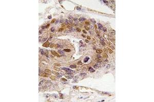 Immunohistochemistry analyzes of paraffin-embedded human colon carcinoma tissue using DIDO1 antibody . (DIDO1 抗体)