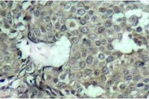 Immunohistochemistry (IHC) analyzes of p-MEK-1/2 antibody in paraffin-embedded human breast carcinoma tissue. (MEK1 抗体  (pSer222, pSer226))