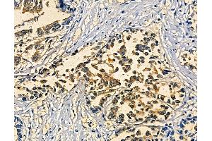 ABIN7094923 and ABIN7098979 at 1/100 staining human pancreatic cancer and adjacent non-tumor tissue by IHC-P. (SOX30 抗体)