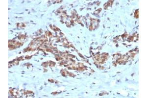 Formalin-fixed, paraffin-embedded human Breast stained with ARF1 Mouse Monoclonal Antibody (ARF1/2117). (ARF1 抗体)
