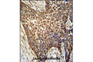 METTL4 antibody immunohistochemistry analysis in formalin fixed and paraffin embedded human Lung carcinoma followed by peroxidase conjugation of the secondary antibody and DAB staining.