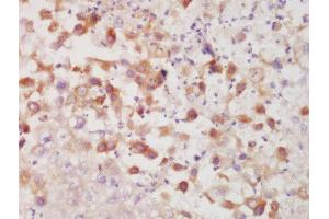 Formalin-fixed and paraffin embedded human lung carcinoma labeled with Rabbit Anti-CK7 Polyclonal Antibody, Unconjugated  at 1:200 followed by conjugation to the secondary antibody and DAB staining (Cytokeratin 7 抗体  (AA 251-350))