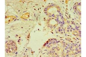 Immunohistochemistry of paraffin-embedded human breast cancer using ABIN7153805 at dilution of 1:100 (GTF2H2C 抗体  (AA 1-260))