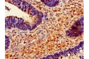 Immunohistochemistry of paraffin-embedded human ovarian cancer using ABIN7167713 at dilution of 1:100 (RMND1 抗体  (AA 35-160))