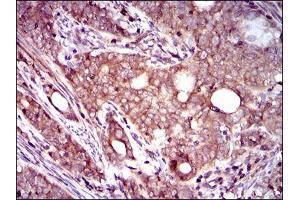 Immunohistochemical analysis of paraffin-embedded cervical cancer tissues using DCTN4 mouse mAb with DAB staining. (Dynactin 4 抗体  (AA 57-298))