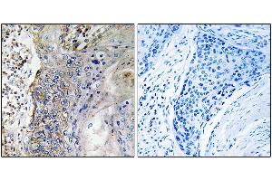 Immunohistochemistry analysis of paraffin-embedded human lung carcinoma tissue, using SLC28A2 antibody. (SLC28A2 抗体)