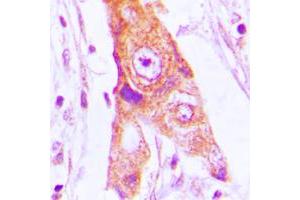 Immunohistochemical analysis of MRPL46 staining in human lung cancer formalin fixed paraffin embedded tissue section. (MRPL46 抗体  (Center))