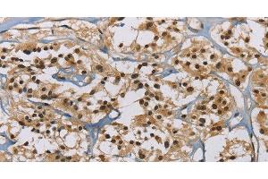 Immunohistochemistry of paraffin-embedded Human thyroid cancer tissue using ACVR1 Polyclonal Antibody at dilution 1:60 (ACVR1 抗体)
