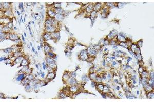 Immunohistochemistry of paraffin-embedded Human lung cancer using MTIF2 Polyclonal Antibody at dilution of 1:100 (40x lens). (MTIF2 抗体)