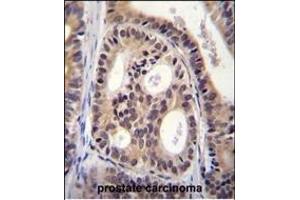 CYTSA Antibody (N-term) (ABIN656040 and ABIN2845411) immunohistochemistry analysis in formalin fixed and paraffin embedded human prostate carcinoma followed by peroxidase conjugation of the secondary antibody and DAB staining. (SPECC1L 抗体  (N-Term))