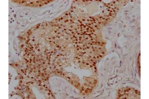 IHC image of ABIN7127775 diluted at 1:100 and staining in paraffin-embedded human prostate cancer performed on a Leica BondTM system. (Recombinant PRMT5 抗体)