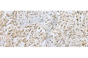 Immunohistochemistry of paraffin-embedded Human ovarian cancer tissue using FOXQ1 Polyclonal Antibody at dilution of 1:25(x200) (FOXQ1 抗体)