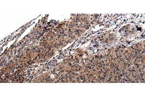 Immunohistochemistry of paraffin-embedded Human cervical cancer tissue using RAB41 Polyclonal Antibody at dilution 1:100 (RAB41 抗体)