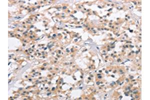 The image on the left is immunohistochemistry of paraffin-embedded Human thyroid cancer tissue using ABIN7190329(COL7A1 Antibody) at dilution 1/25, on the right is treated with synthetic peptide. (COL7A1 抗体)