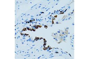Immunohistochemistry of paraffin-embedded human lung cancer using CTSE antibody (ABIN5971444) at dilution of 1/100 (40x lens). (Cathepsin E 抗体)