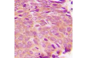 Immunohistochemical analysis of Transglutaminase 2 staining in human breast cancer formalin fixed paraffin embedded tissue section. (Transglutaminase 2 抗体  (N-Term))