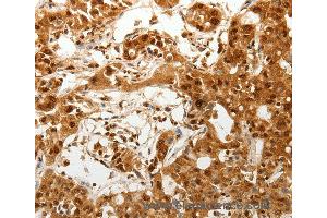 Immunohistochemistry of Human lung cancer using TENM3 Polyclonal Antibody at dilution of 1:50 (TENM3 抗体)