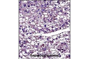 PROC Antibody (Center) (ABIN657466 and ABIN2846494) immunohistochemistry analysis in formalin fixed and paraffin embedded human hepatocarcinoma followed by peroxidase conjugation of the secondary antibody and DAB staining. (PROC 抗体  (AA 177-206))