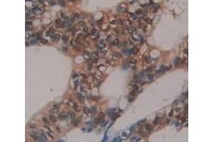 IHC-P analysis of Human Tissue, with DAB staining. (BMI1 抗体  (AA 152-289))