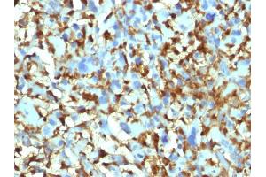 Formalin-fixed, paraffin-embedded human Histiocytoma stained with Factor XIIIa Mouse Monoclonal Antibody (F13A1/1448). (F13A1 抗体  (AA 46-181))
