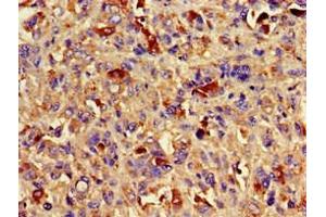 Immunohistochemistry of paraffin-embedded human melanoma using ABIN7145083 at dilution of 1:100 (Aurora Kinase C 抗体  (AA 12-143))