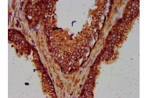 IHC image of ABIN7166132 diluted at 1:600 and staining in paraffin-embedded human prostate cancer performed on a Leica BondTM system. (SMG7 抗体  (AA 694-809))