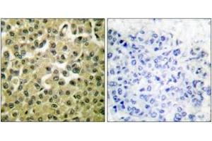 Immunohistochemistry analysis of paraffin-embedded human breast carcinoma tissue, using MCL1 Antibody. (MCL-1 抗体  (AA 91-140))