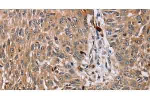 Immunohistochemistry of paraffin-embedded Human lung cancer tissue using PDLIM7 Polyclonal Antibody at dilution 1:35 (PDLIM7 抗体)