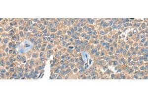 Immunohistochemistry of paraffin-embedded Human ovarian cancer tissue using PPP3R1 Polyclonal Antibody at dilution of 1:55(x200) (PPP3R1 抗体)