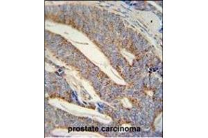 DACT1 antibody (N-term) (ABIN652102 and ABIN2840549) immunohistochemistry analysis in formalin fixed and paraffin embedded human prostate carcinoma followed by peroxidase conjugation of the secondary antibody and DAB staining. (DACT1 抗体  (N-Term))