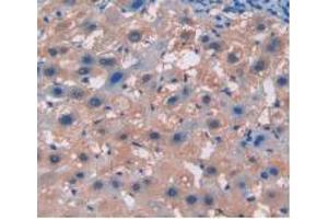 IHC-P analysis of Human Liver Cancer Tissue, with DAB staining. (Integrin beta 5 抗体  (AA 137-378))