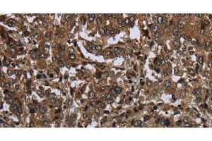 Immunohistochemistry of paraffin-embedded Human liver cancer tissue using GLIPR1 Polyclonal Antibody at dilution 1:50 (GLIPR1 抗体)