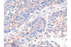 IHC-P analysis of Human Breast Cancer Tissue, with DAB staining. (Cathepsin K 抗体  (AA 54-317))