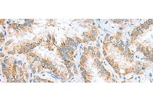 Immunohistochemistry of paraffin-embedded Human lung cancer tissue using RIDA Polyclonal Antibody at dilution of 1:65(x200) (HRSP12 抗体)
