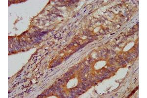 IHC image of ABIN7143628 diluted at 1:100 and staining in paraffin-embedded human colon cancer performed on a Leica BondTM system. (AARS 抗体  (AA 164-321))