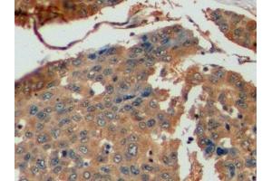 Detection of TYMS in Human Liver cancer Tissue using Polyclonal Antibody to Thymidylate Synthetase (TYMS)